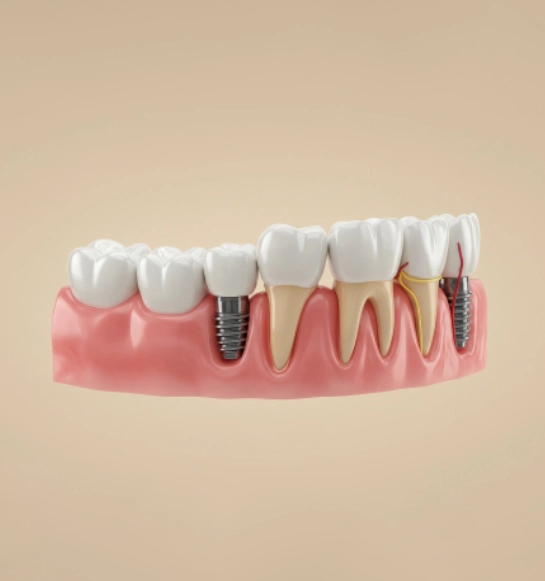 Dental Implants