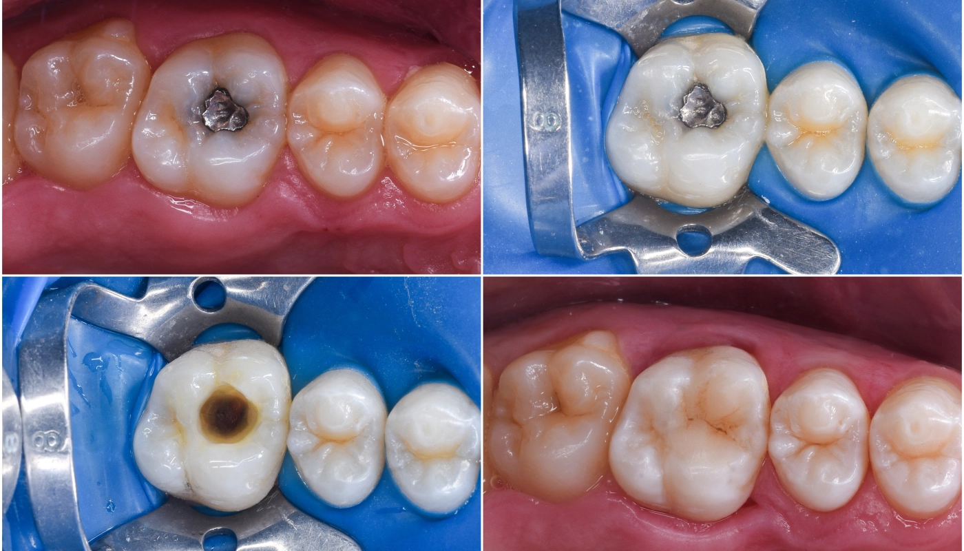 tooth color