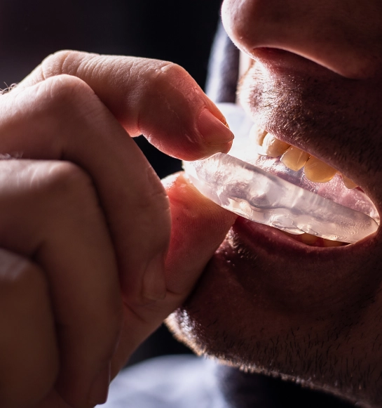 Occlusal Guards, Sports Guards & Retainers