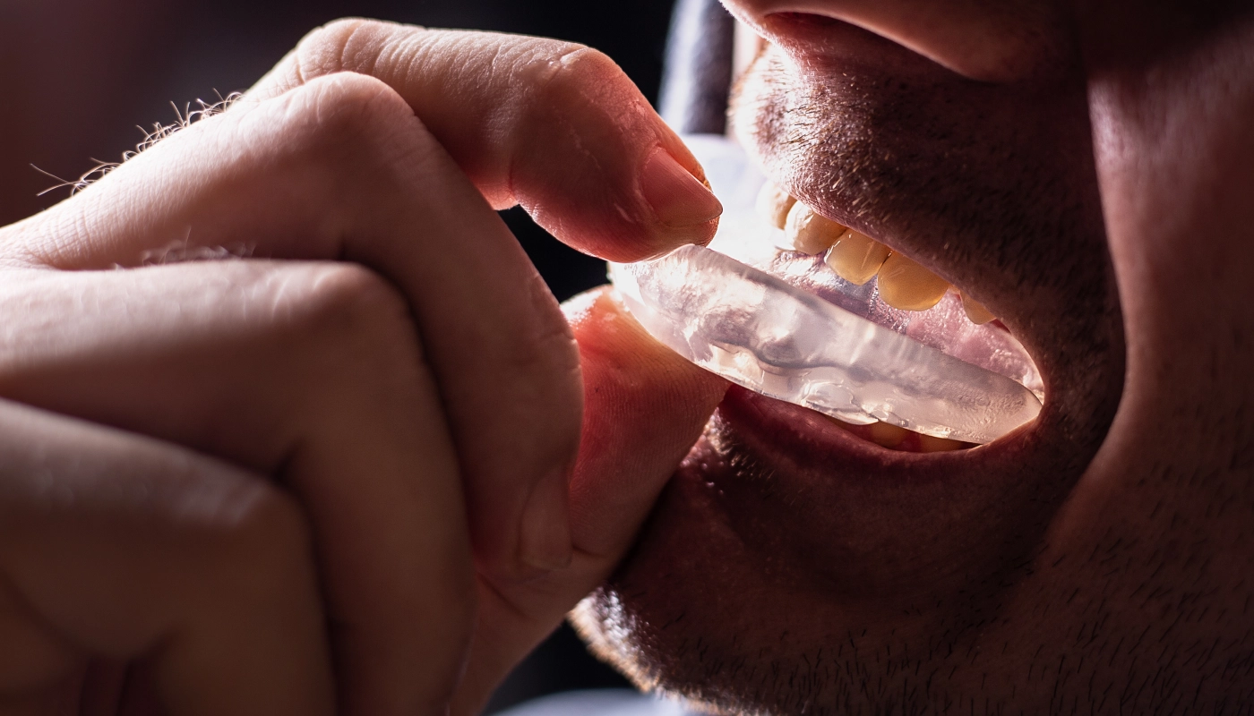 Occlusal Guards, Sports Guards & Retainers