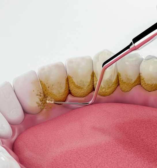 Periodontal (Gum) Care