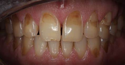Tooth erosion